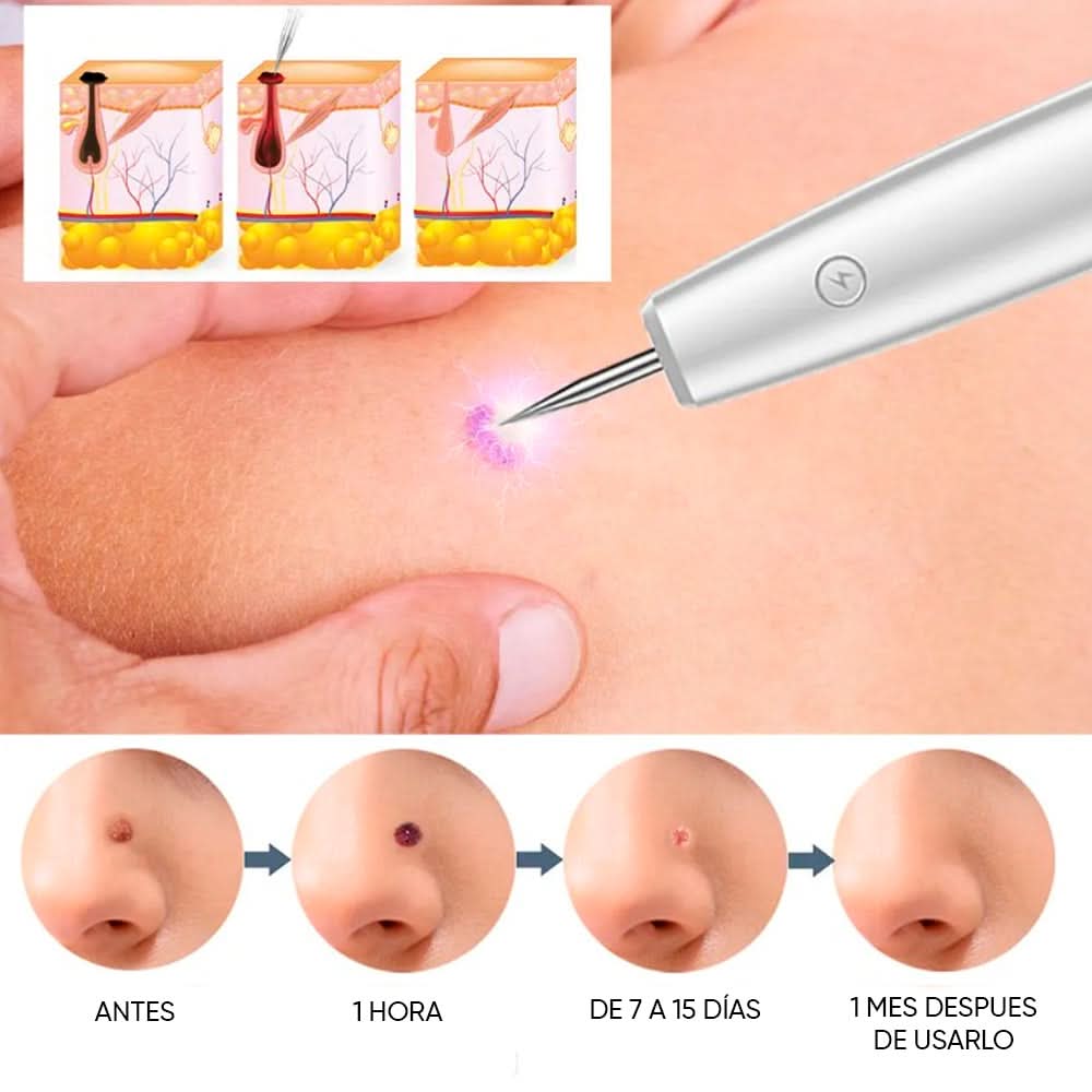 Lápiz cauterizador de plasma en uso – Mil Ideas