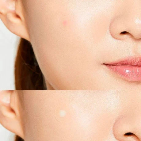 Acne Pimple Master parches curativos en uso – Mil Ideas